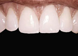 Veneer
